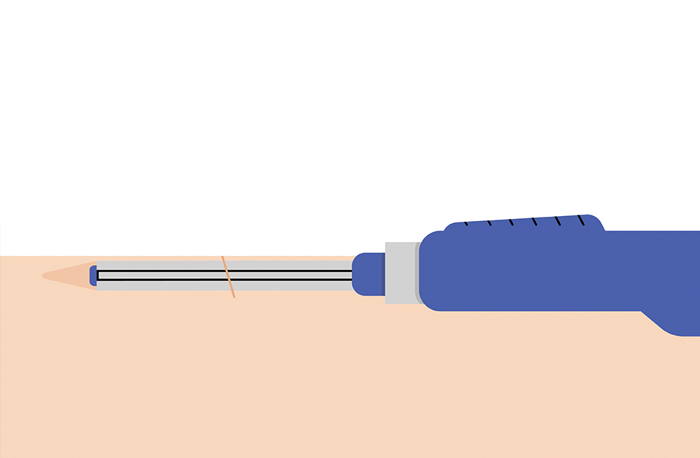 El segundo paso del proceso de inserción del sistema de MCG implantable Eversense.