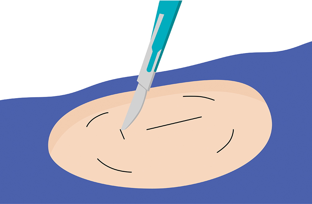 Primer paso del proceso de inserción y extracción de un monitor de glucosa llevable.